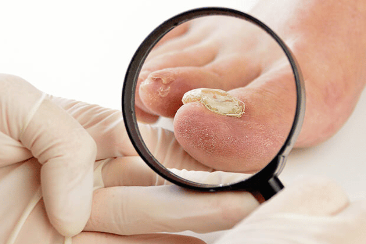 nail fungus testing